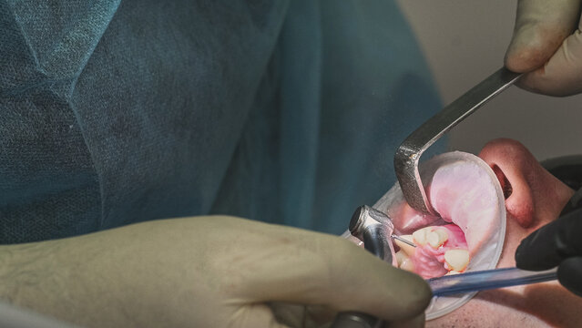 Dentist treating patient teeth with professional dental instruments and drill, while saliva ejector is used during close-up oral procedure without visible face