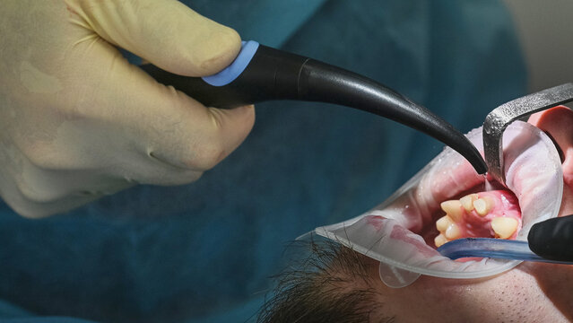 dental air-water syringe using Close-up view of tooth treatment using dental instruments, with dentist working inside patient mouth and assistant operating saliva ejector, no face visible