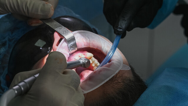 Close-up dental treatment with dentist using specialized instruments inside patient mouth, saliva ejector maintaining clear treatment area, face not visible dental air-water syringe