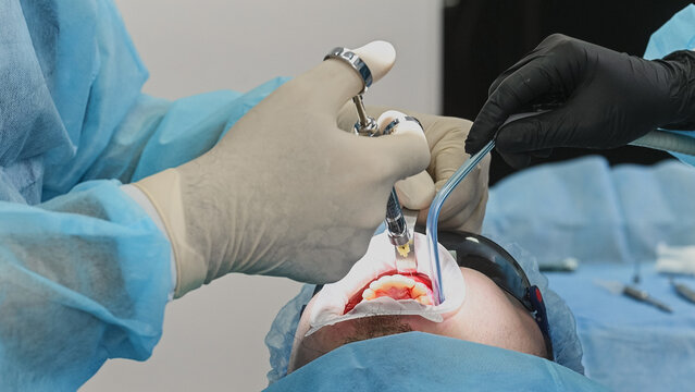 Dental surgeon injecting local anesthetic into patient gum before treatment, carefully performing anesthesia procedure with sterile gloves and dental instruments