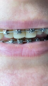 A close-up of a girl's face with braces, smiling broadly, yellow plaque and tartar are visible on her crooked teeth. Orthodontic treatment, oral care, and teeth cleaning