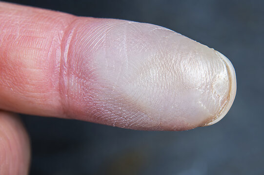 Pale White Fingertip with Color Change for Circulation Assessment, Vascular Examination and Raynaud Phenomenon Clinical Illustration