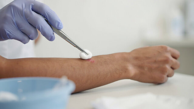 medical professional cleaning patient wound with cotton swab and tweezers