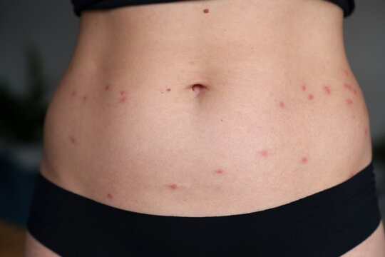 Harvest mite bites causing red itchy rash on woman abdomen