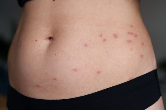 Harvest mite bites causing red itchy rash on woman abdomen