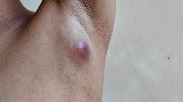 Close-Up View of an Inflamed Skin Boil on Underarm
