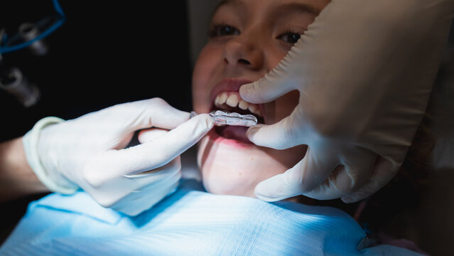 Dentist fitting clear aligner to child's teeth