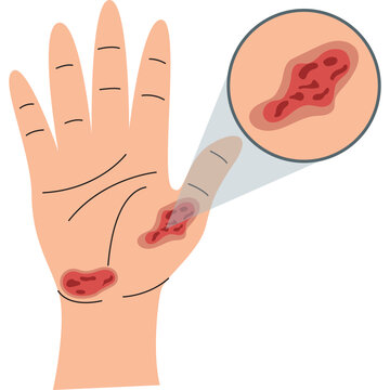Illustration of World Diabetes Day designation