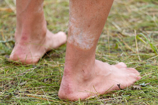 Bare feet stand on green grass. Skin shows patchy discoloration.
