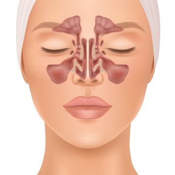 Detailed medical illustration of a female face showing the anatomy and location of the paranasal sinuses, including maxillary and frontal sinuses, nasal cavity and surrounding structures.