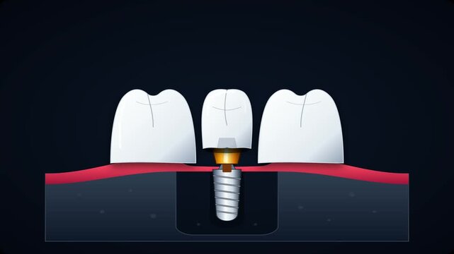Dental Implant Procedure Animation - Tooth Replacement Vector Motion Graphics