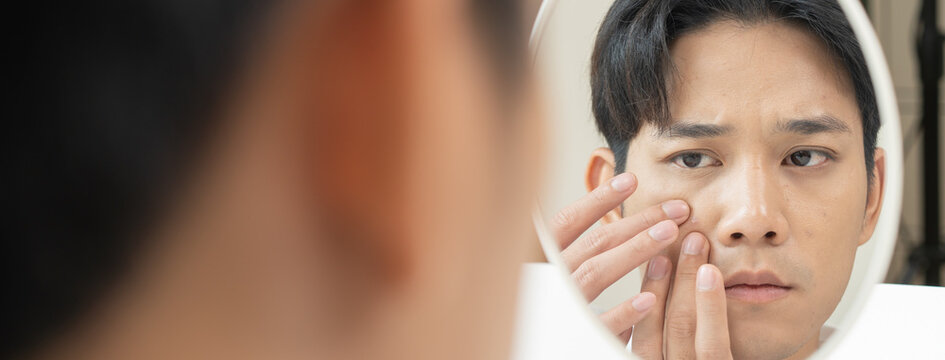 Asian men worry about acne on their faces when looking in the mirror