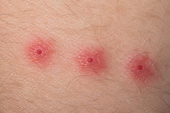 Three Red Insect Bite Lesions on Skin Close Up Showing Localized Swelling, Irritation and Allergic Reaction for Dermatology and Medical Diagnosis