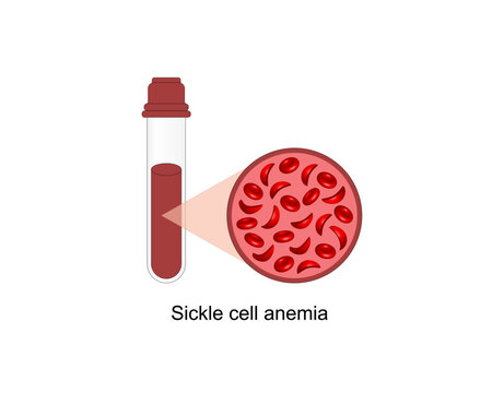 Sickle cell anemia, disease. Normal red blood cell and sickle cell. Gene mutation. Vector illustration.