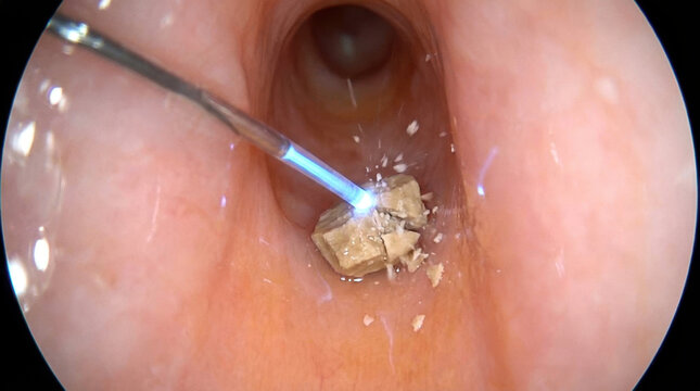 Endoscopic urinary laser targeting calculus during minimally invasive ureter treatment with illuminated scope and pink tissue visible, showing precise medical intervention and clinical procedure