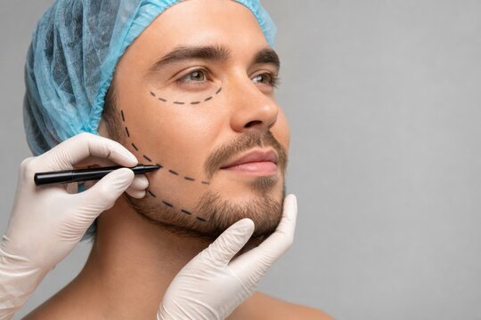 Male patient with facial surgery markings during preoperative cosmetic surgery consultation