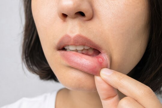 Close up of woman showing painful mouth ulcer on inner lower lip with finger