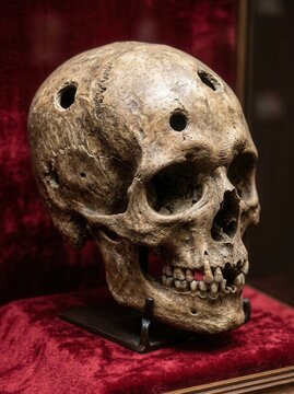 Ancient Human Skull Exhibited With Multiple Trepanation Holes For Historical Medical Study