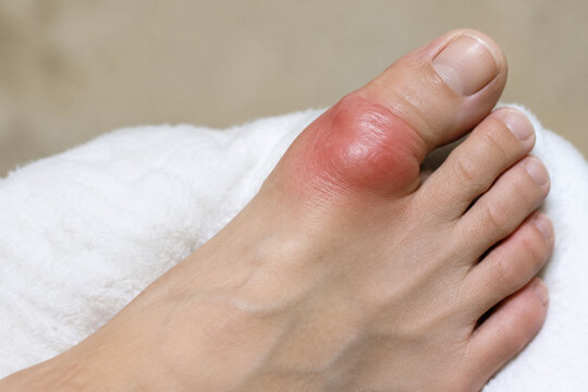 Swollen big toe joint on white cushion, gout and inflammation concept