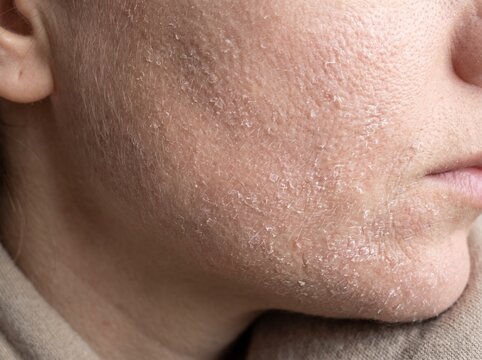 Close-up of dry flaky skin texture on a human face showing signs of dehydration or skin condition.