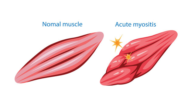 Acute myositis