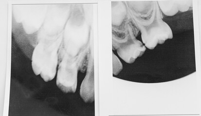 Black and white dental X-ray showing upper teeth and roots. Concept of dentistry, oral health, medical diagnostics, and dental care © leroy