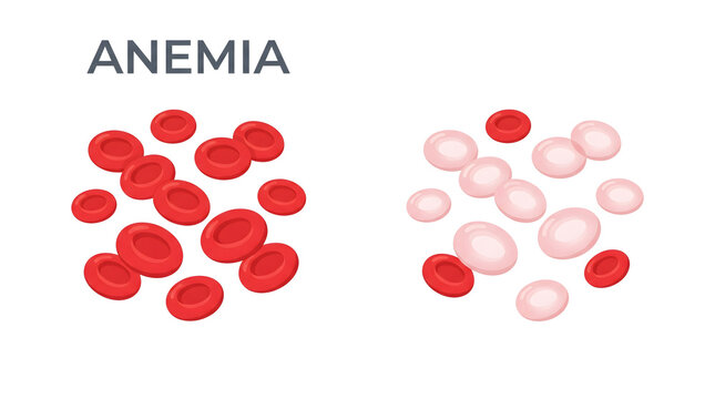 Medical comparison showing healthy red blood cells and anemic pale cells