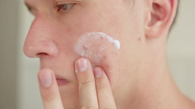  Skin care treatment for men. Man applying medicated cream to acne blemishes on his cheek. Close up of a person applying lotion to moisturize bad skin. Curing acne. Medical treatment of skin.