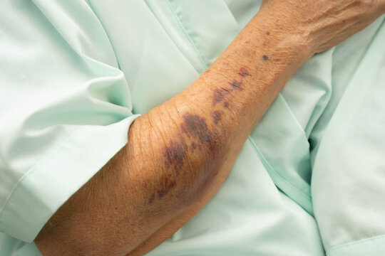 Ecchymosis, elderly bleeding on her arm after taking aspirin.