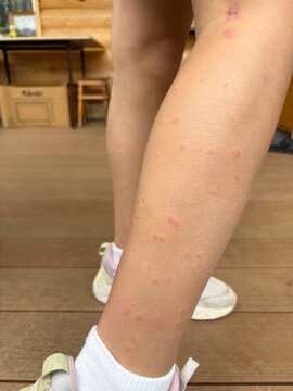 A child&rsquo;s leg covered in mosquito bites, close‑up. Country house, midges.
