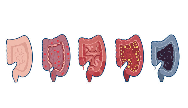 Medical comparative diagram showing different stages and conditions of human colon health and pathology.