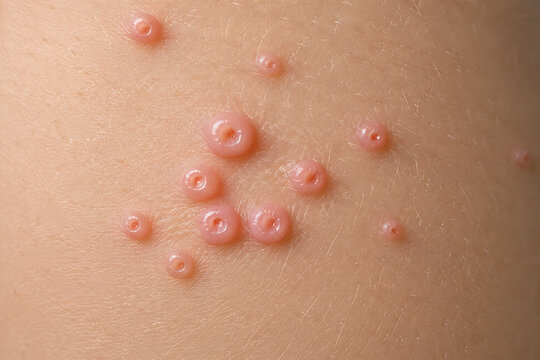Molluscum Contagiosum Skin Papules with Central Dimples for Dermatology Diagnosis, Viral Infection Examination and Clinical Healthcare Vector
