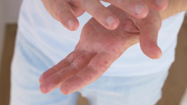 Rash covered hands turn palms upward, showing irritated skin linked to eczema, dermatitis, allergy, or Coxsackie virus. Person examines both hands with visible discomfort and concern.