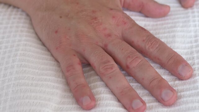 Rash covered hands lie still on white cloth, with visible redness across knuckles and fingers. Eczema or dermatitis appears likely, and allergy or coxsackie virus remains supported medical context.