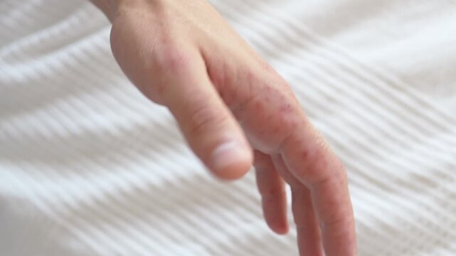 Rash on hand skin points toward eczema, dermatitis, allergy, or Coxsackie virus. Hand stays extended on light bedding, with mild redness and scattered spots showing irritated dermatology concern.