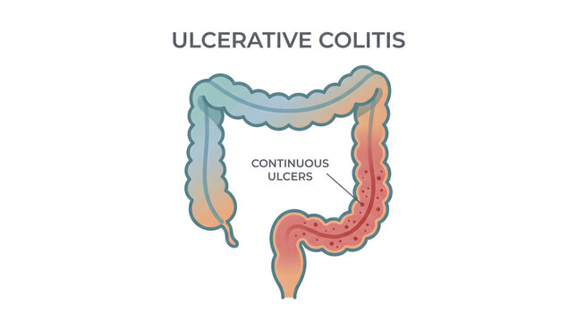 Medical illustration depicting ulcerative colitis and continuous ulcers in the colon