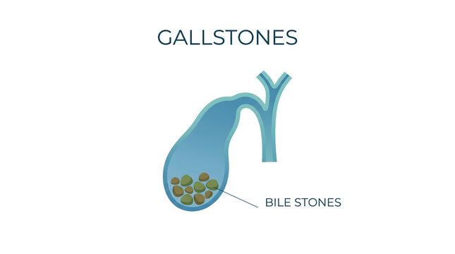 Medical illustration depicting gallstones inside a human gallbladder organ