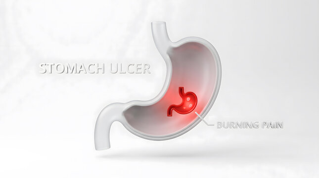 Medical illustration of a stomach ulcer showing internal inflammation and pain