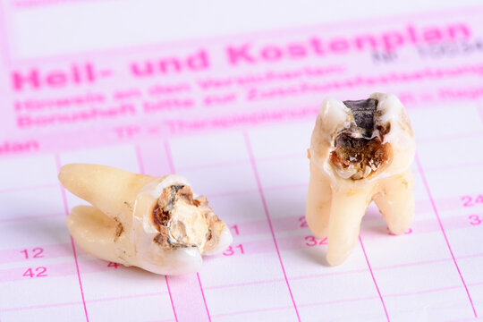 Auf einem Heil- und Kostenplan liegt ein extrahierter Backenzahn mit Karies und Amalgamf&uuml;llung
