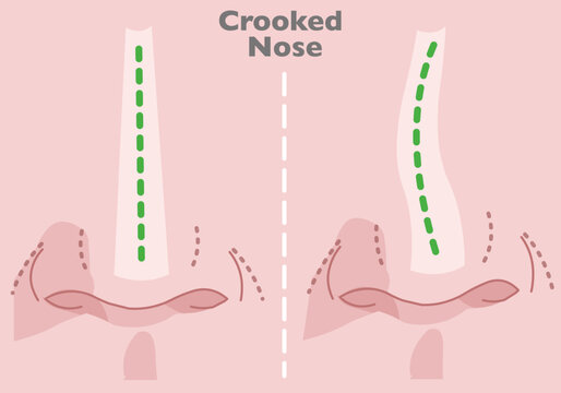 Crooked nose rhinoplasty. Surgery job. Shape size problem. Front view curve. surgical procedure, before after. Skin color background. Illustration vector	