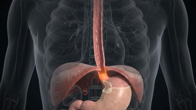 Gastroesophageal Reflux Showing Sphincter Relaxation and Esophageal Irritation for Medical Education