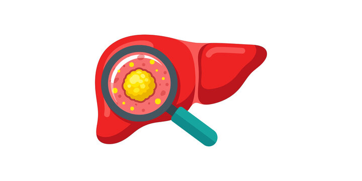 Red liver with magnifying glass examining yellow diseased cells for medical and healthcare concepts.