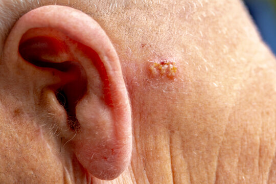 Health and medical concept, Selective focus of a cluster of skin rash vesicles and blisters on human skin near the ear, Typical of a localized Herpes zoster (shingles) or Herpes simplex virus outbreak