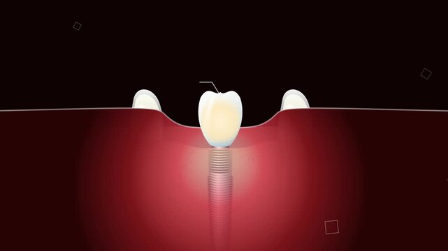 3D medical animation detailing a titanium dental implant structure with labels for biomimetic crown, gingival collar, osseointegration micro-threads, and apical chamfer primary stability