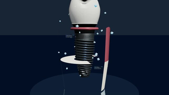 3D animation of a dental implant procedure showing a cross section of a titanium screw placed in the jaw bone with an abutment and artificial crown for tooth restoration