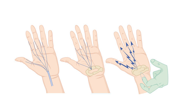 Hand Nerve Gliding Exercise, Illustration showing nerve gliding movements of the hand and wrist.
