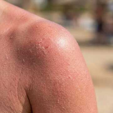 Sunburn Blisters And Peeling Skin On Shoulder From Overexposure