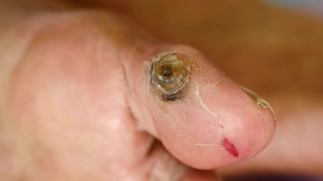 Macro view of foot with infected skin corn and callus showing painful texture and inflammation on toe surface