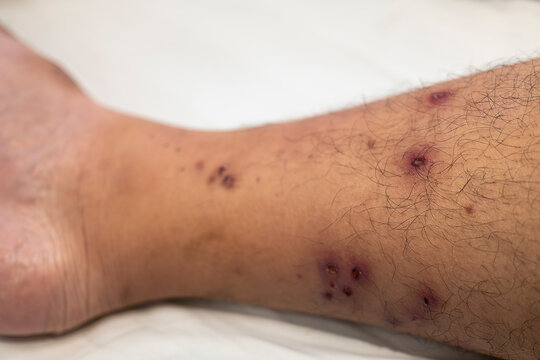 Dermatology and skin infection concept with close up of insect bite marks, scabbed itchy red spots and dermatitis rash on human leg for medical diagnosis, allergy clinic and wound therapy.
