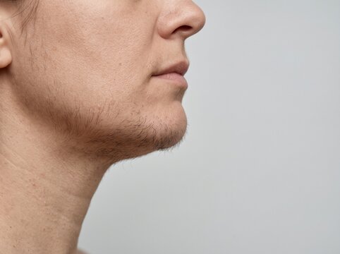 Close-Up of Female Facial Hirsutism With Excessive Chin and Jawline Hair Growth